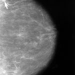 Mamografía mostrando un cáncer de mama