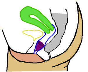 colocacion copa menstrual